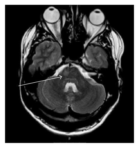 Mri Scan Of Brain Mri Of Brain Axial T2 Weighted Image Showing T2