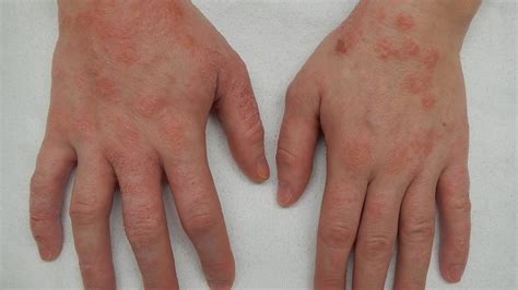 Dermatitis Herpetiformis Causes Symptoms Diagnosis Treatment