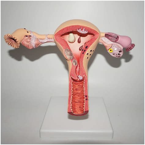 Buy Fmoge Pathological Uterus Ovary Model Human Organ Anatomy Model