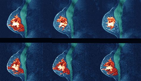Study Women With Dense Breast Tissue May Benefit From Regular Mris Time