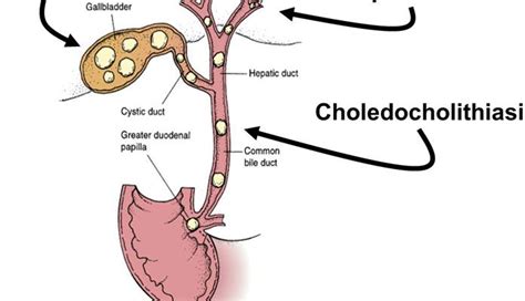 10 Facts Of Choledocholithiasis Bile Duct Gallbladder Gallstones