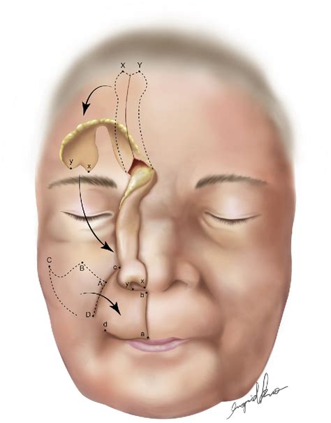 Figure From Nasolabial And Forehead Flap Reconstruction Of Contiguous