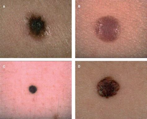 Small Nodular Melanoma The Beginning Of A Life Threatening Lesion A