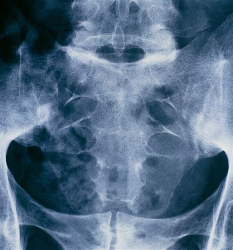 X Ray Of Pelvis And Sacral Spine Bild Kaufen 11834996 Science Photo