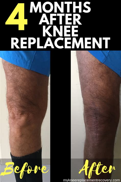 4 Months After Knee Replacement Surgery Pain And Progress Knee