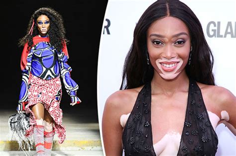 winnie harlow at lfw everything you need to know about her skin condition vitiligo mens and