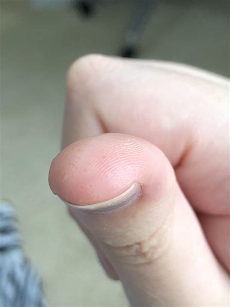 I Usually Get These Small Clear Fluid Filled Bumps On My Fingers It