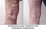 Endovenous Laser Treatment Images
