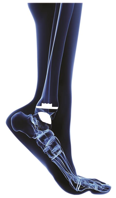Ankle Replacement Surgery Advanced Foot And Ankle Center Of San Diego