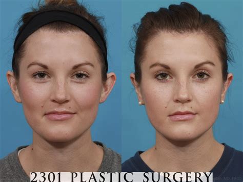 Ear Surgery Otoplasty For Fort Worth And Plano Tx 2301 Plastic Surgery