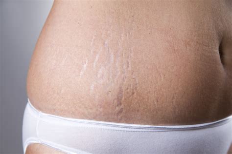 The Truth About Stretch Marks Ozderm