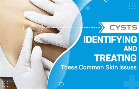 Cysts Identifying And Treating These Common Skin Issues