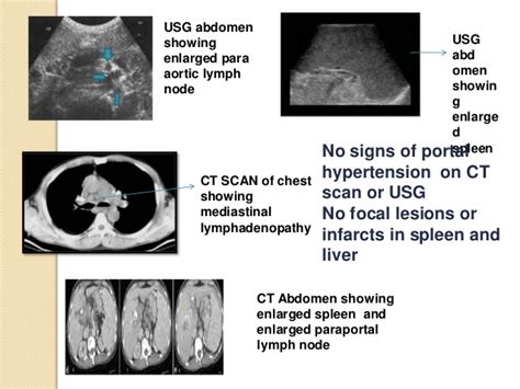 Para Aortic Lymphadenopathy Differential Diagnosis