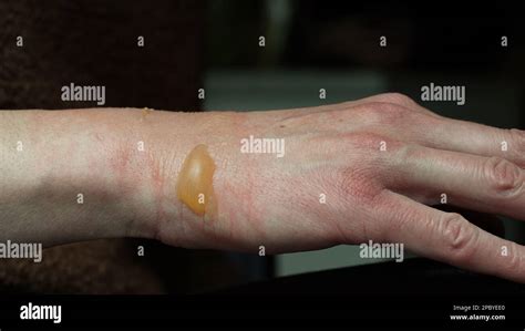 Close Up Of A Womans Hand With A Blister From A Boiled Water Burn