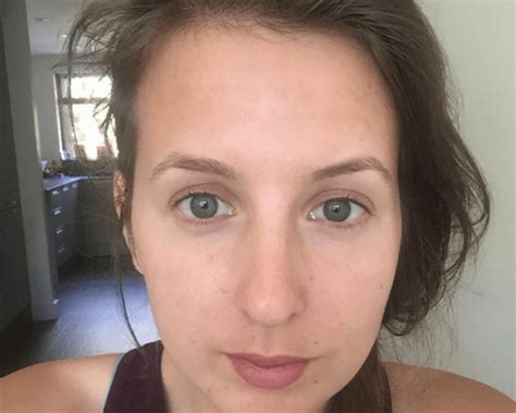How I Cleared My Tiny Bumps On Forehead Once And For All Forehead