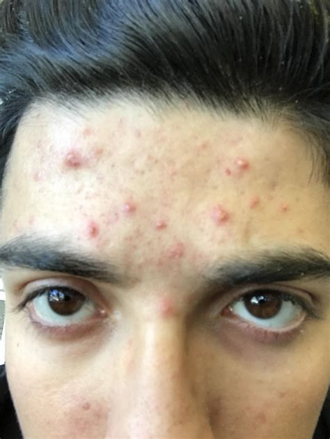 Acne On Forehead Getting Worse General Acne Discussion