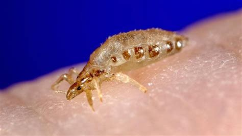 Body Lice Symptoms Diagnosis And Treatment Everyday Health