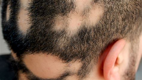 Getting Rid Causes Of Balding In Men