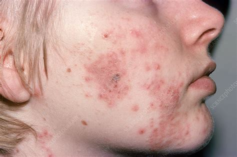 Cystic Acne Stock Image C0031318 Science Photo Library