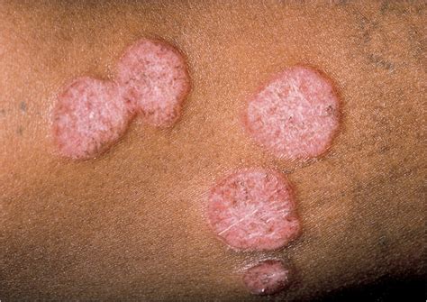 What Causes Circular Lesions On Skin Eshealthtips