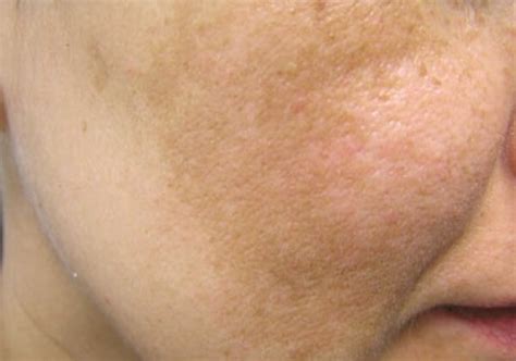 Melasma Chloasma Pictures Causes Symptoms And Treatment
