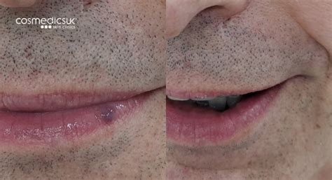 Venous Lake Blood Blister Lip Treatment London Vein Centre