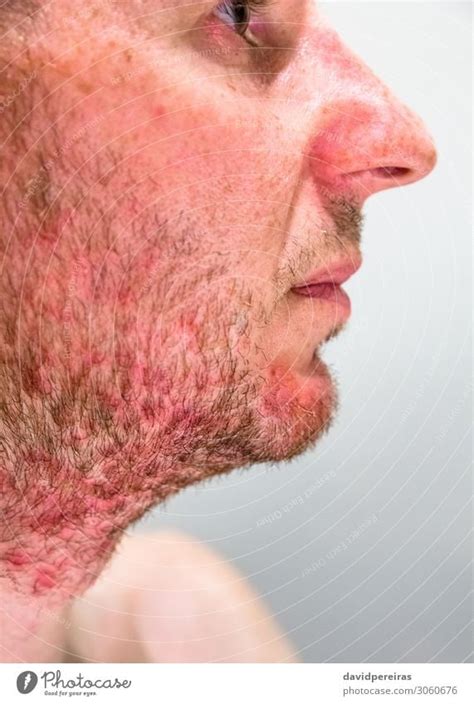 Mans Chin With Seborrheic Dermatitis In Beard A Royalty Free Stock