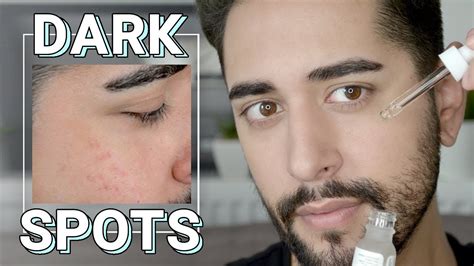 How To Remove Dark Spots On Face Pt 2 Cosmetics And Grooming For Oily