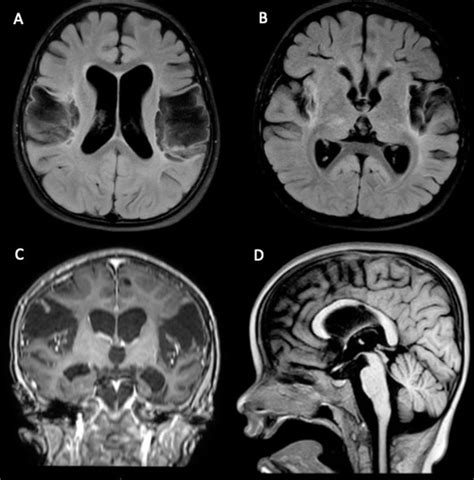 Cureus Atypical Brain Mri Findings In A Child With Delayed Diagnosis