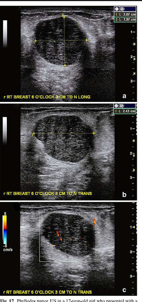 Ultrasound Of Pediatric Breast Masses What To Do With Lumps And Bumps