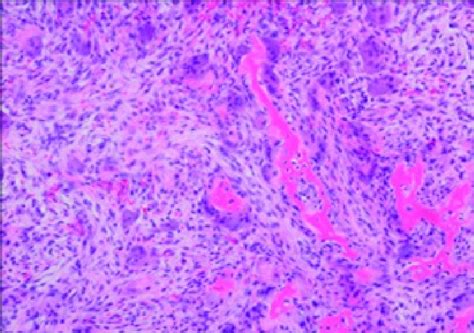 Central Giant Cell Granuloma Demonstrating Numerous Multinucleated