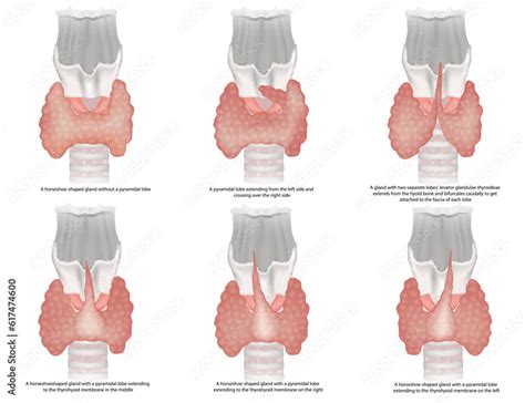 Illustration Of The Classification Of The Thyroid Gland Shapes The