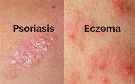 What Is The Difference Between Psoriasis And Eczema Quora
