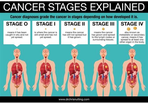 dr chris nutting cancer stages explained