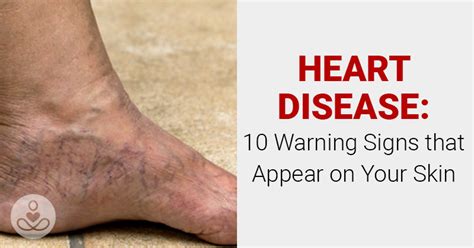 Heart Disease 10 Warning Signs That Appear On Your Skin The Hearty Soul