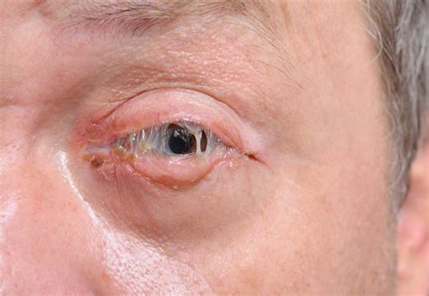 Bacterial Conjunctivitis What Is It And Treatment Rea Oftalmol Gica