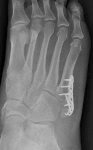 Jones Fracture Mr Malik Orthopaedic Foot And Ankle Consultant