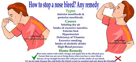 Nosebleeds First Aid Faculty Of Medicine