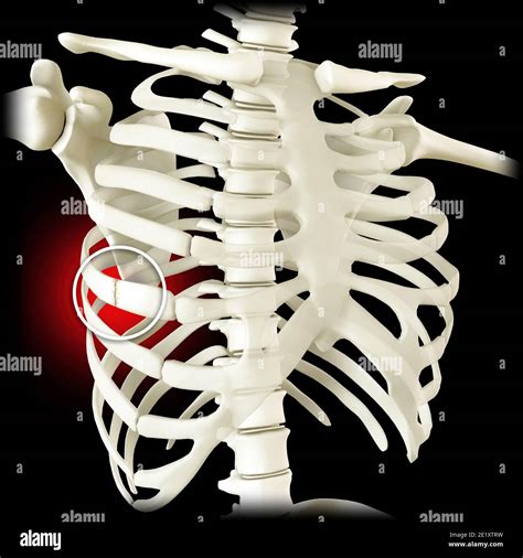 Rib Fracture Hi Res Stock Photography And Images Alamy