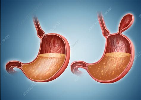 Stomach With And Without Hernia Stock Image F0121774 Science