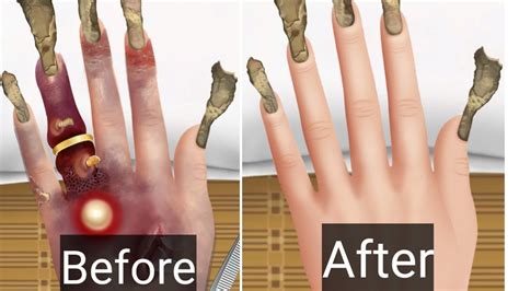 Asmr Remove Worm Infection Asmr Hand Treatment Animation Video Asmr