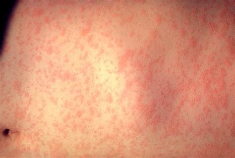 Viral Exanthem Pictures Treatment Symptoms Causes