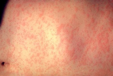 Who get affected by viral rashes? Viral Exanthem - Pictures, Treatment, Symptoms, Causes ...