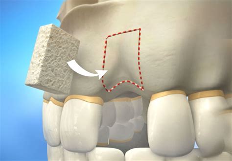 Bone Graft For Dental Implants Brooklyn Heights Brooklyn Fort Greene