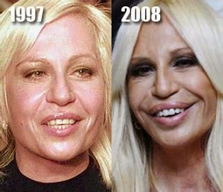 Donatella Versace Plastic Surgery Before And After Disaster Photos Youarebabedarling