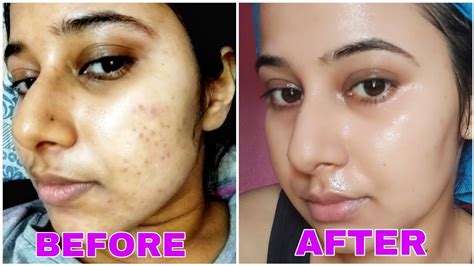 7 Days Challenge Get Rid Of Tiny Bumps On Face Naturally Simple
