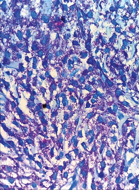 A Rare Case Of Aggressive Systemic Mastocytosis Manifesting With