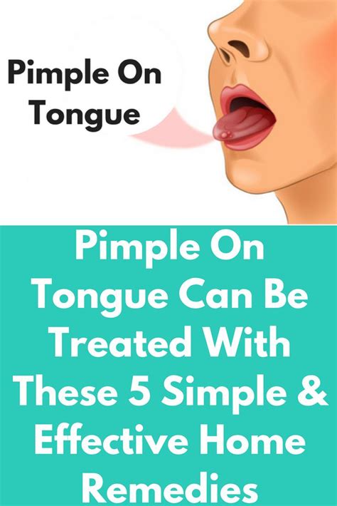 Pimple On Tongue Can Be Treated With These 5 Simple And Effective Home