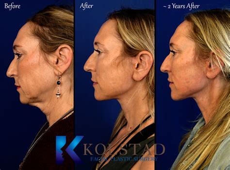 Facelift Before And After Gallery 15 Dr Kolstad San Diego Facial