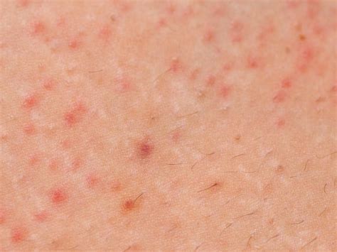 Skin Diseases You Can Get At The Gym Including Ringworm